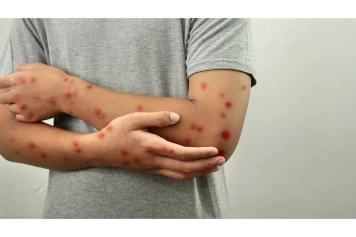 New measles case registered in Moldova