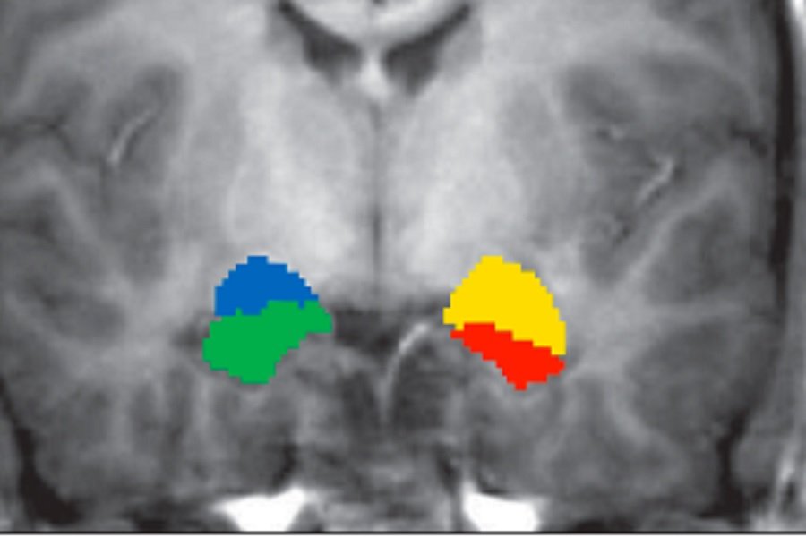 Marijuana shrinks key part of brain