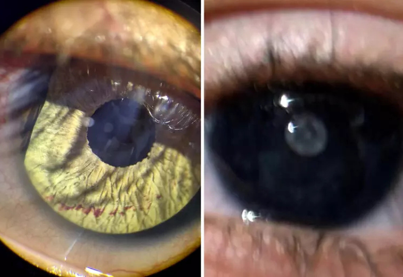 Surgeons perform groundbreaking surgery to save siblings from blindness